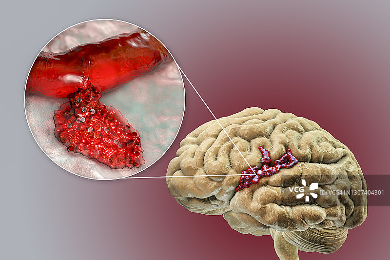 出血性中风插图图片素材
