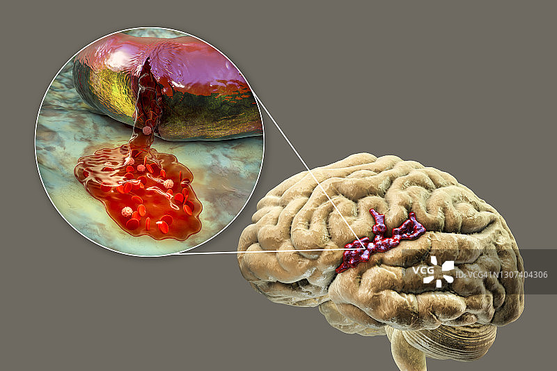 出血性中风插图图片素材