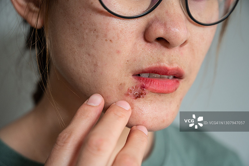 女性下唇唇疱疹疼痛特写图片素材