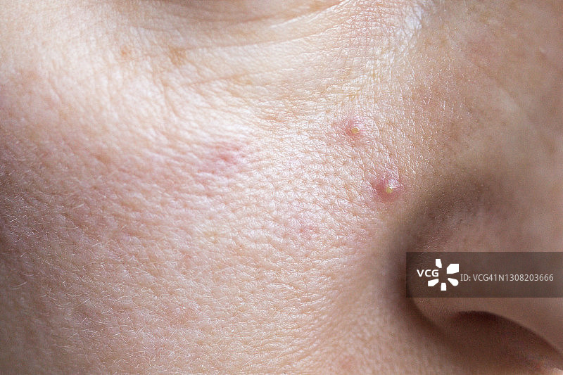 面部粉刺油性皮肤特写图片素材