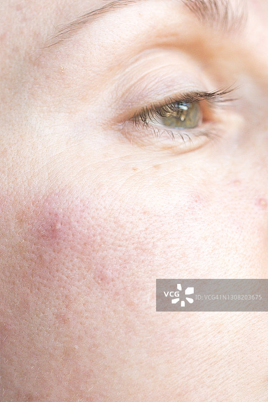 脸颊上的痘痘，长痘痘的女人，成人痤疮图片素材