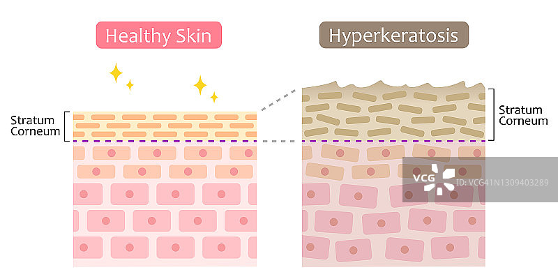 皮肤细胞更新和角质层增厚示意图，护肤美容概念图片素材