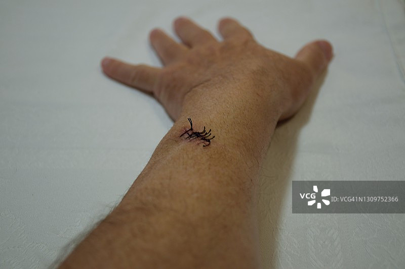 切除癌后的疤痕图片素材