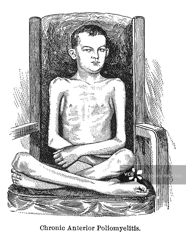 脊髓灰质炎感染的症状和进展的老式雕刻插图图片素材