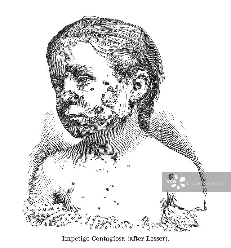 皮肤病古老雕刻插图：非大疱性脓疱病或传染性脓疱病图片素材