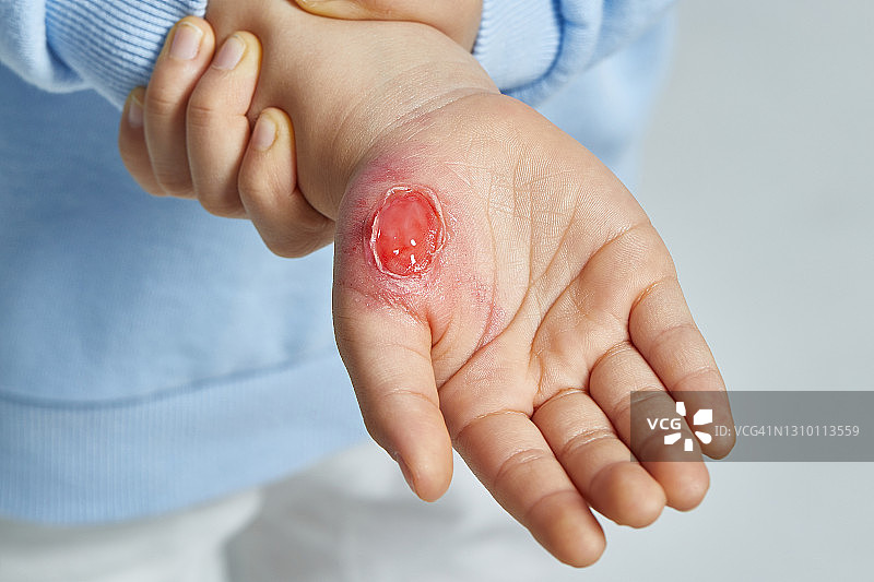 有伤疤的儿童图片素材