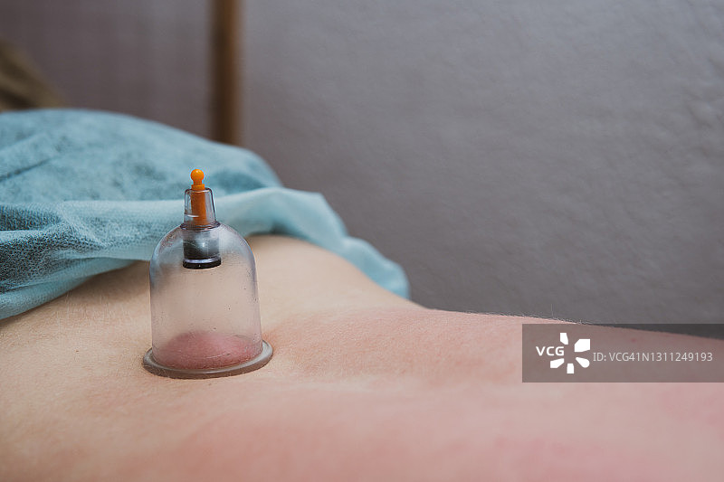 拔罐按摩疗法：缓解背痛的替代疗法图片素材