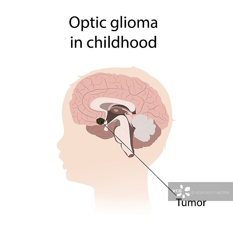 儿童期视神经胶质瘤插图图片素材