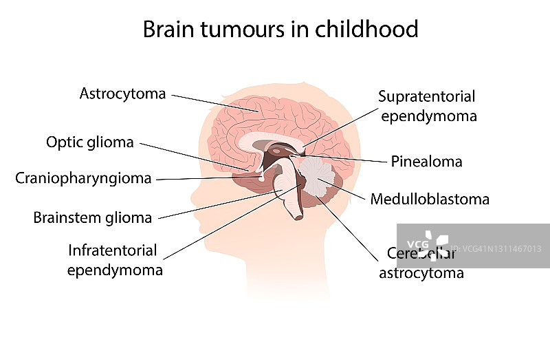 儿童脑肿瘤插图图片素材