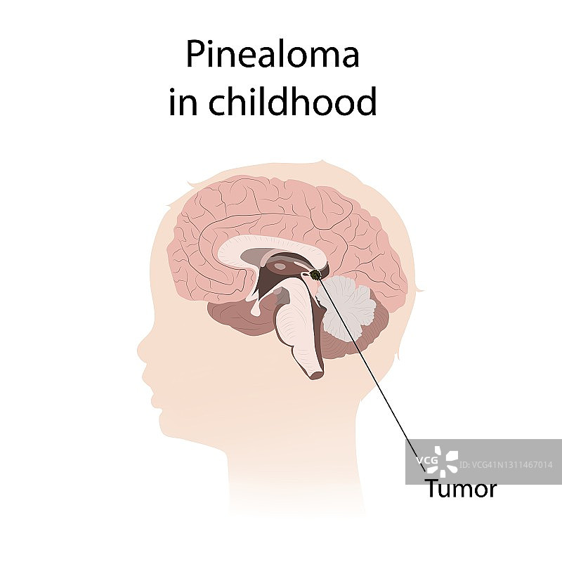 儿童时期的松果体瘤插图图片素材