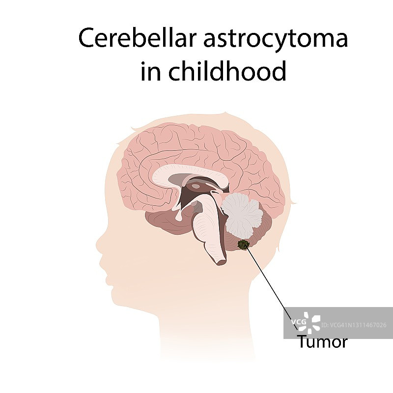 儿童期小脑星形细胞瘤插图图片素材