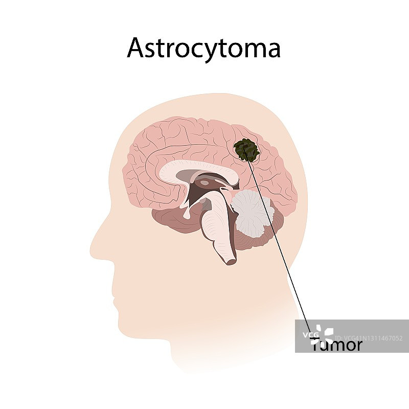 星形细胞瘤插图图片素材