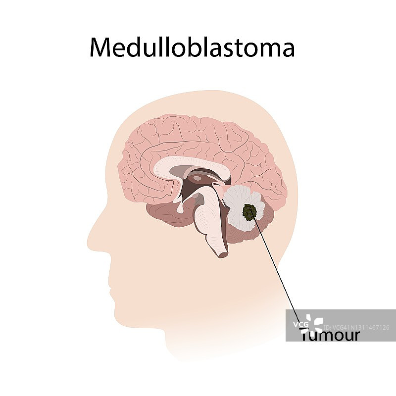 髓母细胞瘤，图示图片素材