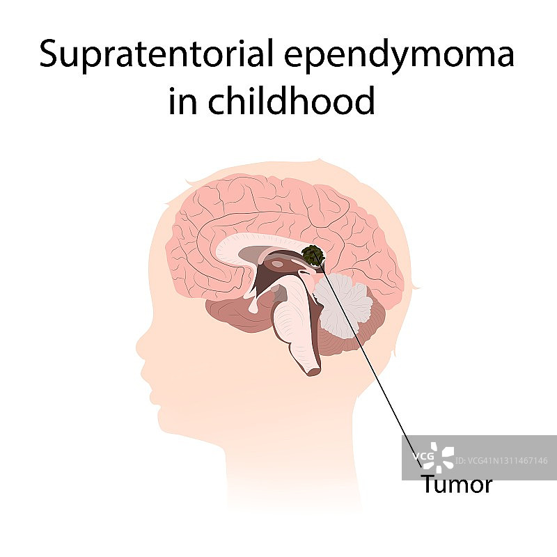 儿童幕上室管膜瘤插图图片素材