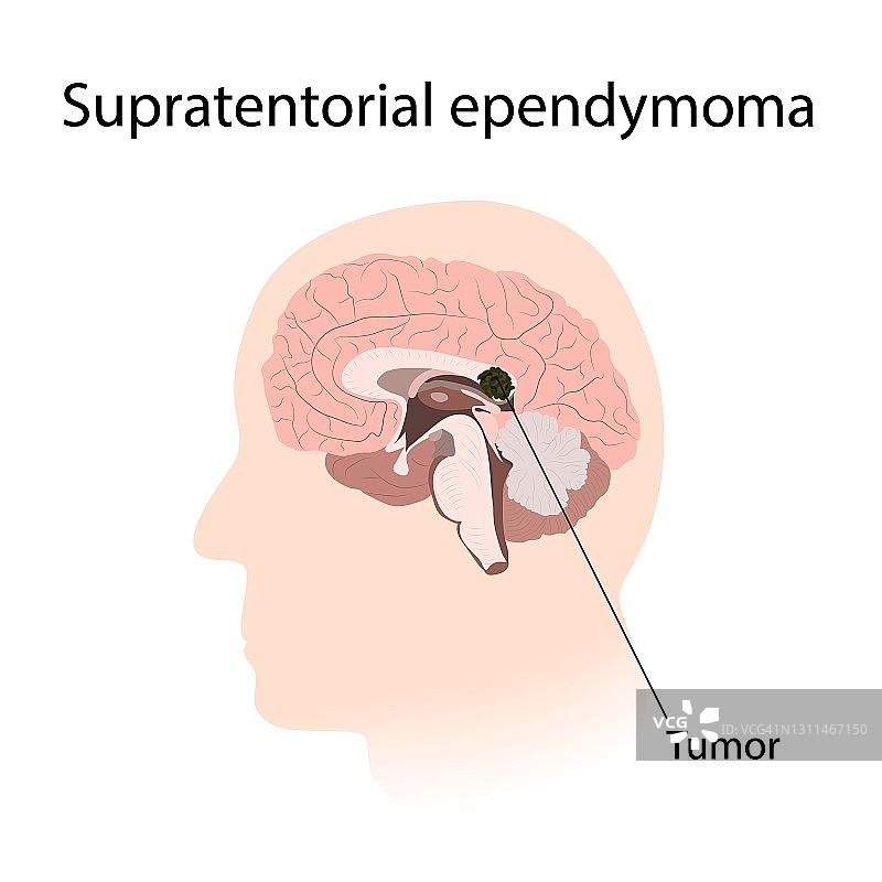 幕上脑室管膜瘤插图图片素材