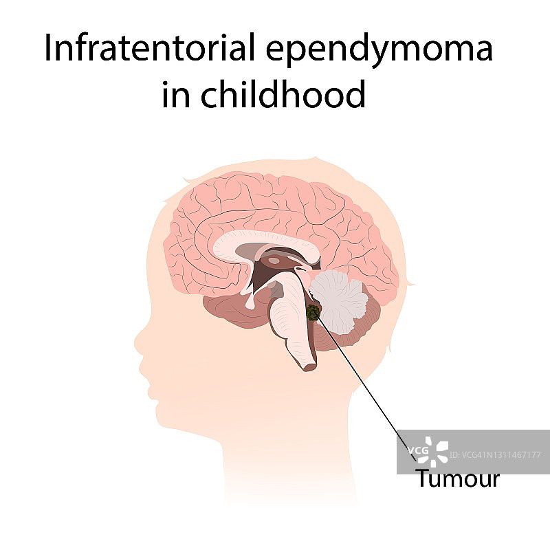 儿童小脑幕下室管膜瘤插图图片素材
