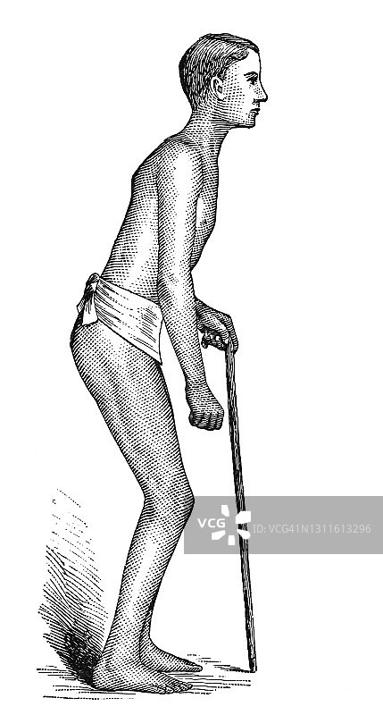 慢性脊髓炎，脊髓炎症老式雕刻插图图片素材