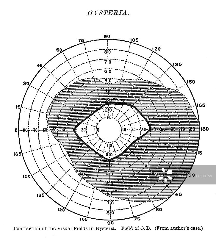 癔症患者视野收缩古老雕刻插图图片素材