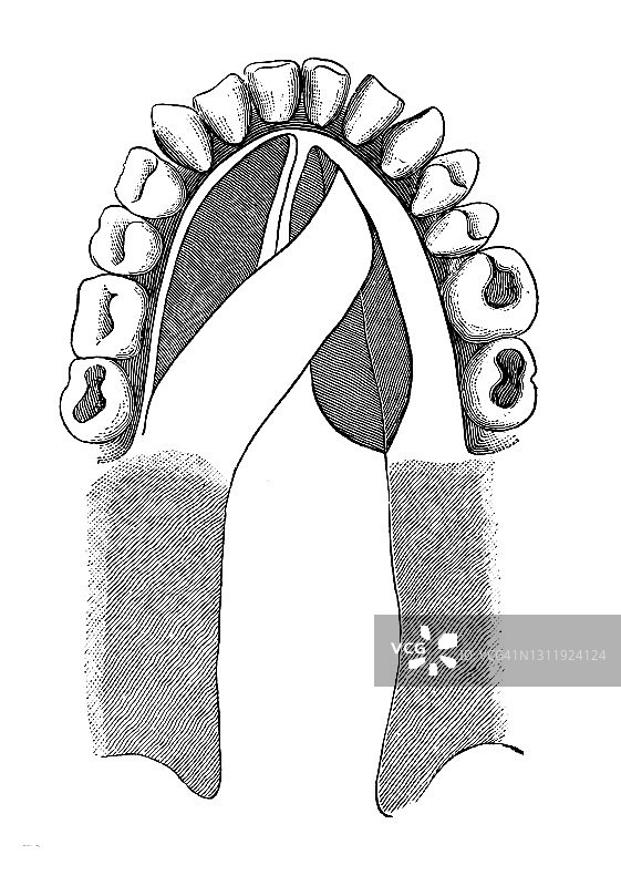 闭合硬腭宽阔裂缝的方法（戴维斯-科利之后）旧版雕刻插图图片素材