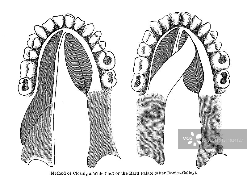 闭合硬腭宽阔裂缝的方法（戴维斯-科利之后）旧版雕刻插图图片素材