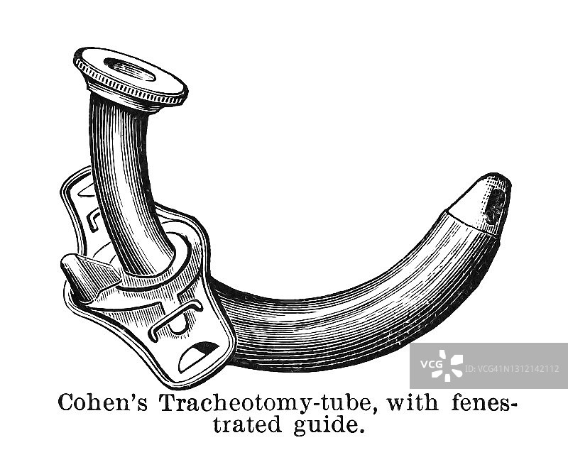 科恩气管切开术管的古老版画插图，带有开窗导管图片素材