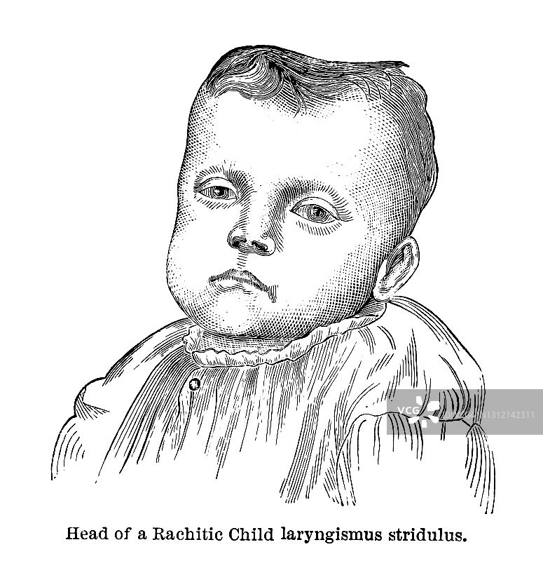 纽约婴儿收容所中患佝偻病儿童头部的古老雕刻插图图片素材