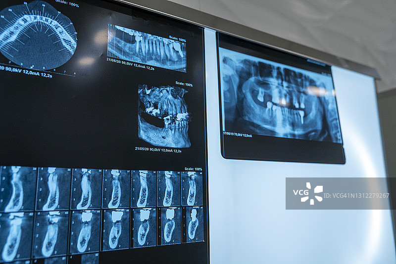 背光X光牙科图像图片素材