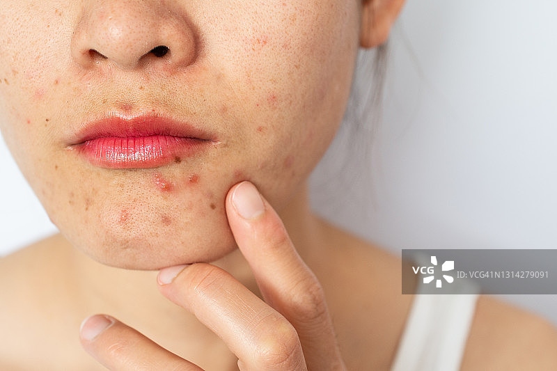 面部痤疮发炎（丘疹和脓疱）的女士头像照片图片素材