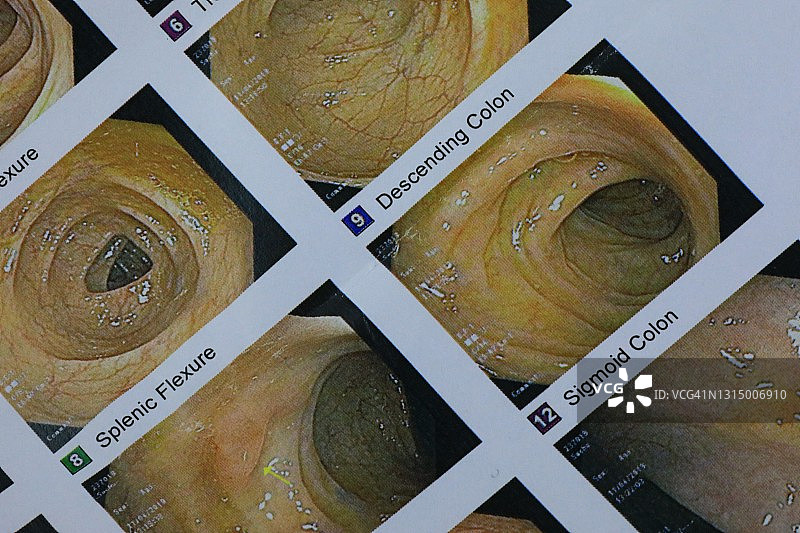 结肠镜检查图像图片素材