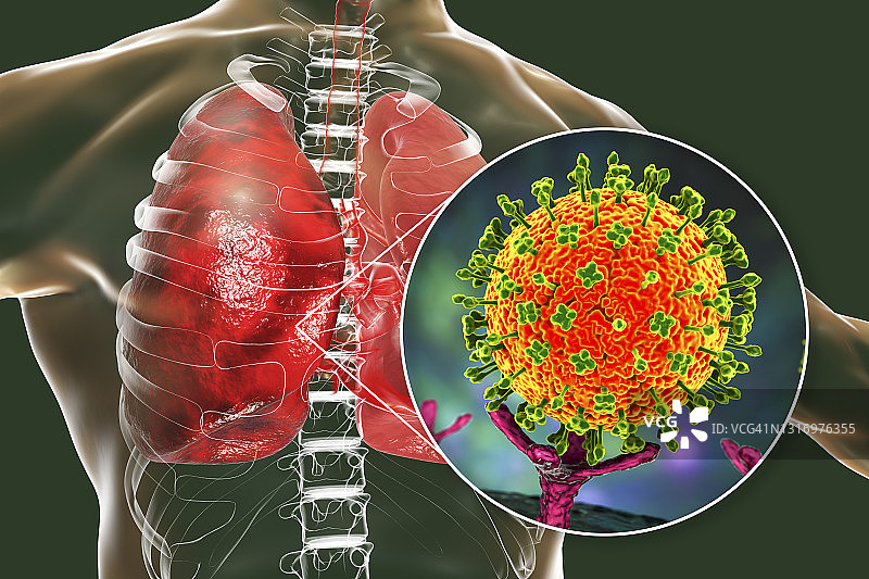 肺部中的尼帕病毒插图图片素材