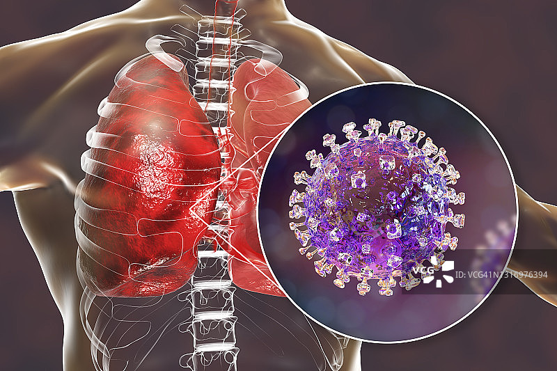肺部中的尼帕病毒插图图片素材