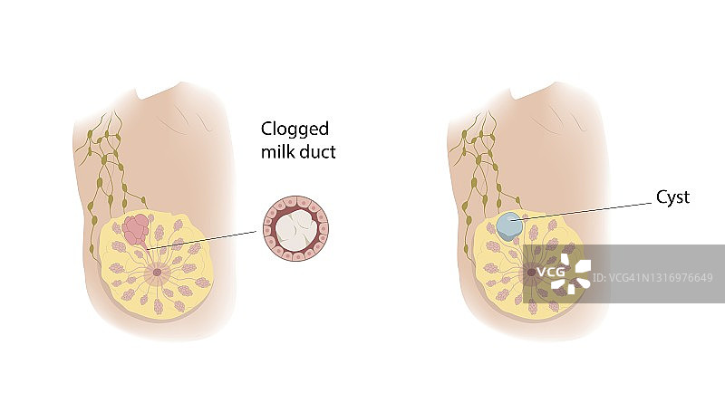 乳腺导管堵塞与囊肿插画图片素材