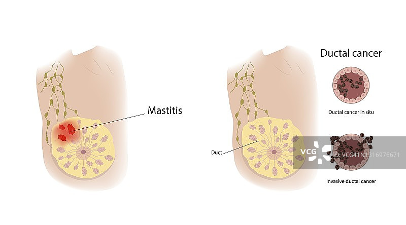 乳腺炎和导管癌插图图片素材