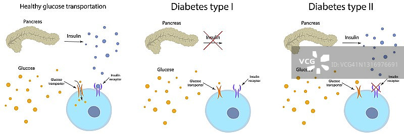 糖尿病与健康的葡萄糖代谢，图示图片素材