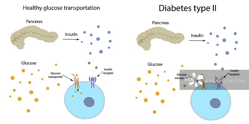 2型糖尿病与健康葡萄糖代谢图图片素材