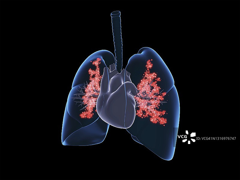 病毒性肺部感染插图图片素材