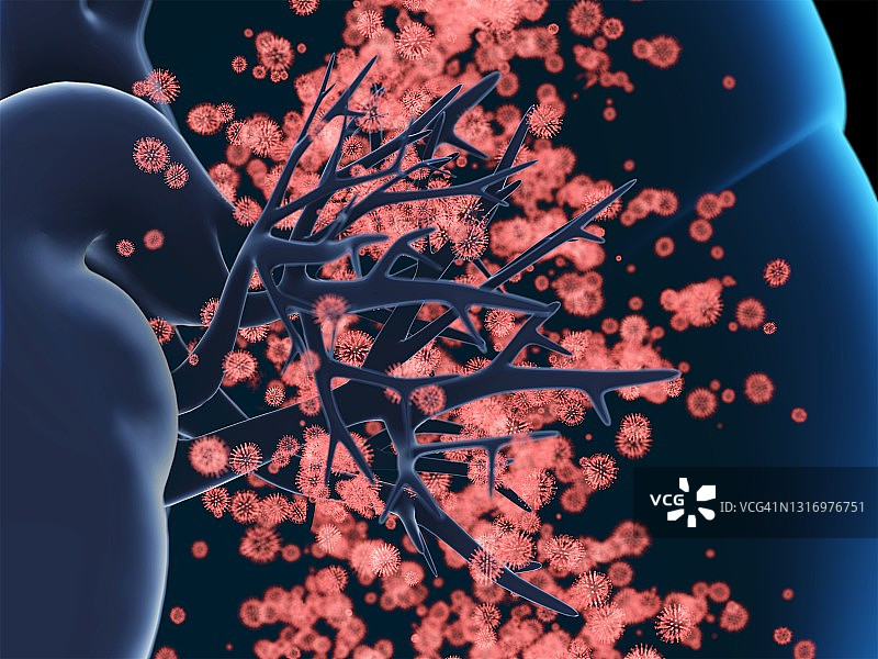 病毒性肺部感染插图图片素材