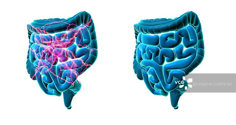 健康与不健康的肠道概念图图片素材