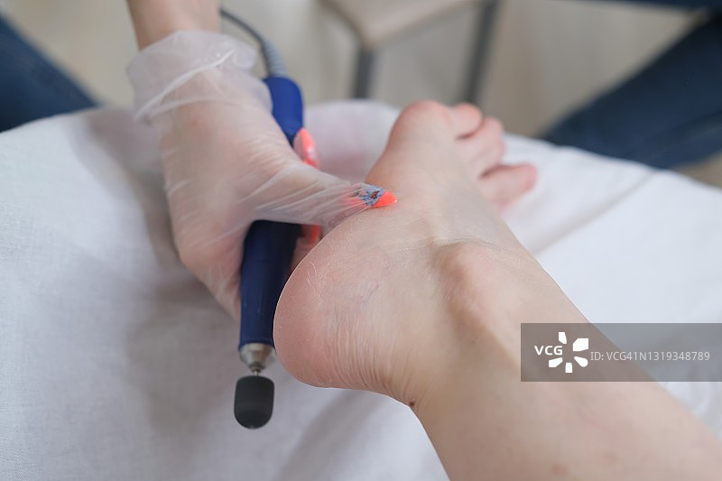 足病治疗：足病医生治疗脚趾甲真菌，去除老茧，治疗嵌甲，进行器械修脚，关注健康与身体护理图片素材