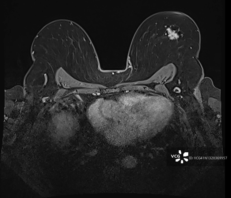 乳腺MRI显示左乳肿瘤病灶轴位图图片素材
