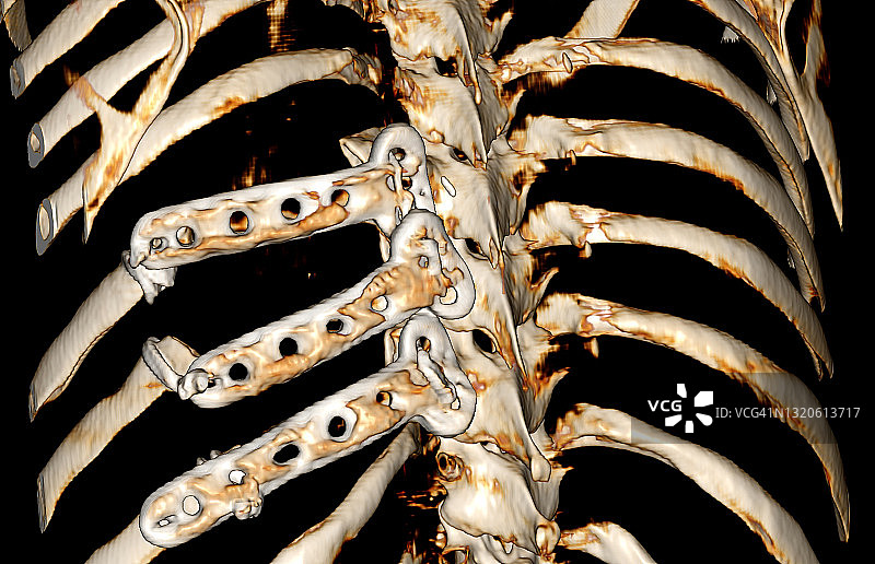 植入胸壁的钛金属肋骨3D CT计算机断层扫描重建图片素材