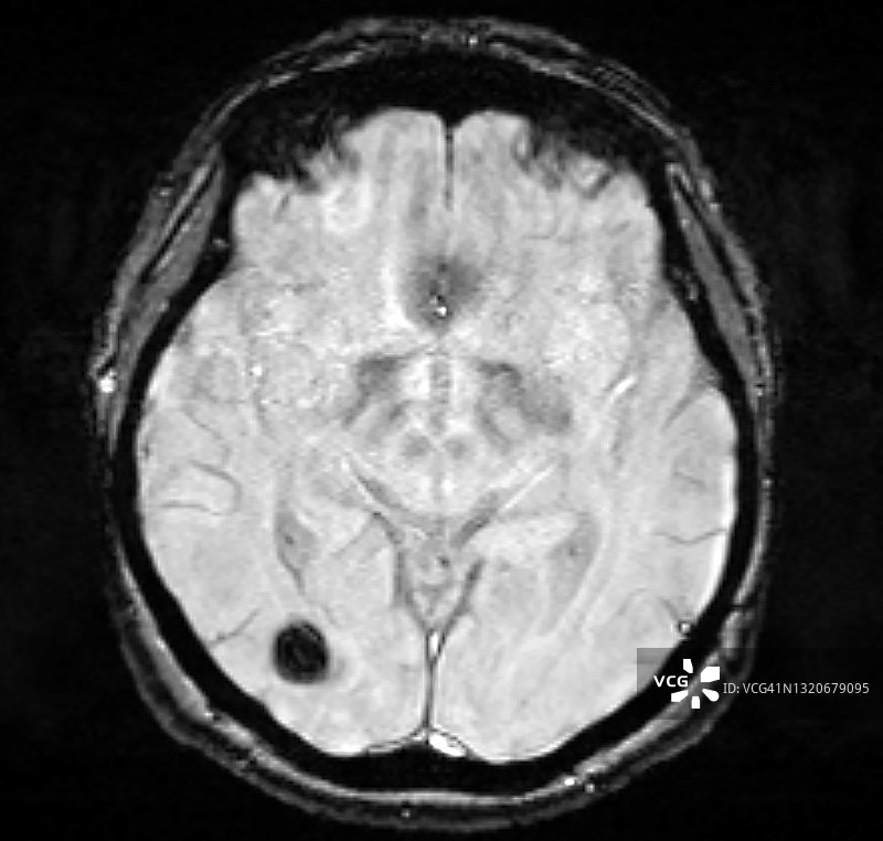 脑血管畸形（海绵状血管瘤）梯度MRI图像图片素材