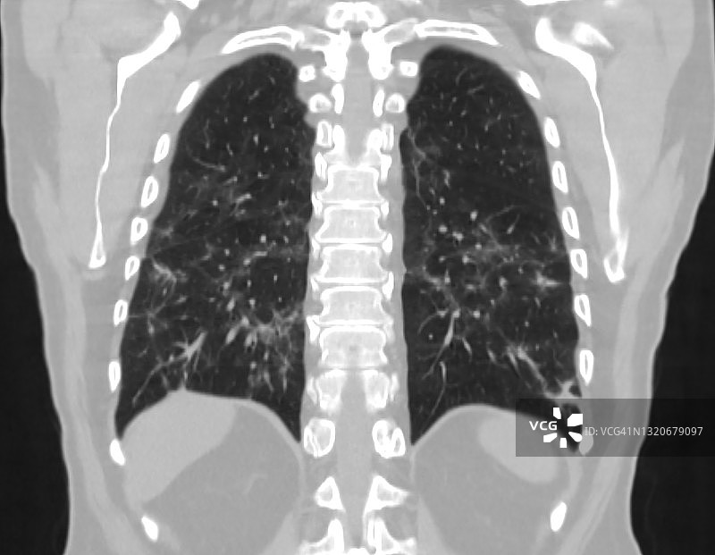 新型冠状病毒COVID-19胸部CT扫描，冠状位图图片素材