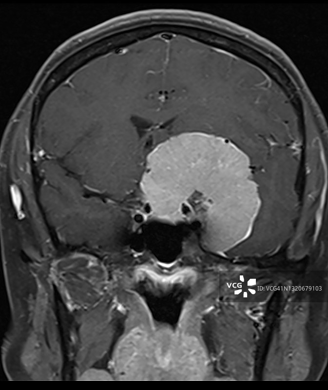 良性脑肿瘤（蝶骨脑膜瘤）的MRI，冠状位，钆注射后图片素材