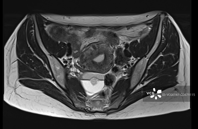 女性盆腔MRI检查中看到的卵巢皮样囊肿和成熟囊性畸胎瘤轴位图图片素材