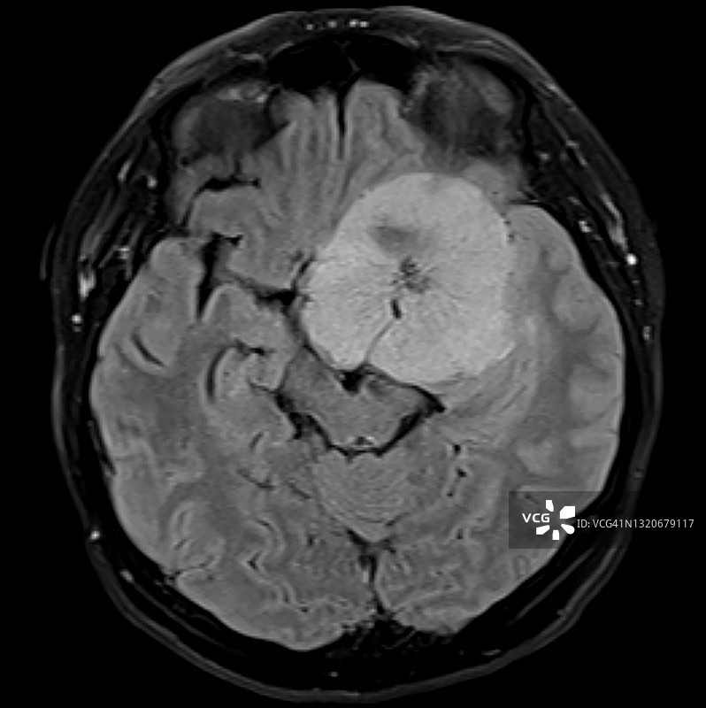 良性脑肿瘤（蝶骨脑膜瘤）的MRI，轴位Flair视图图片素材
