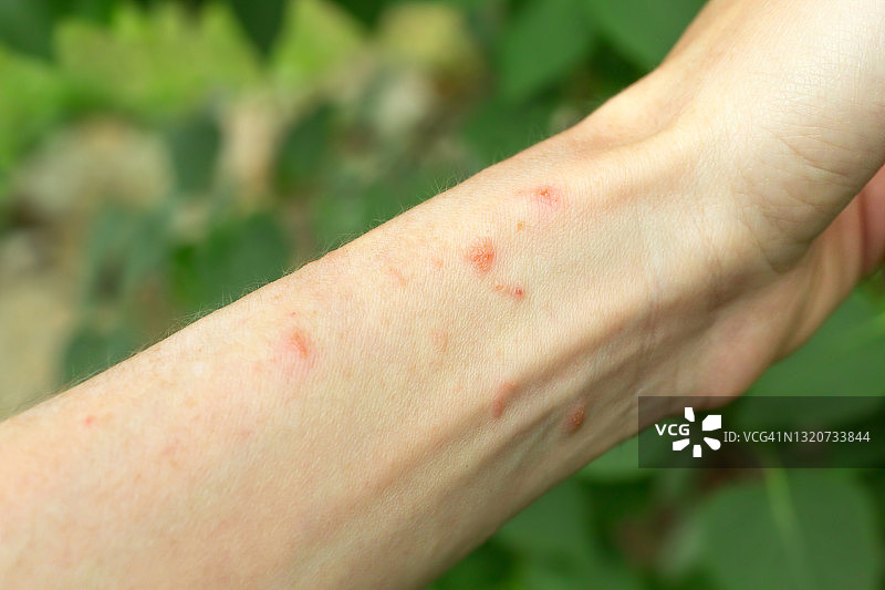 手臂上的毒常春藤皮疹图片素材