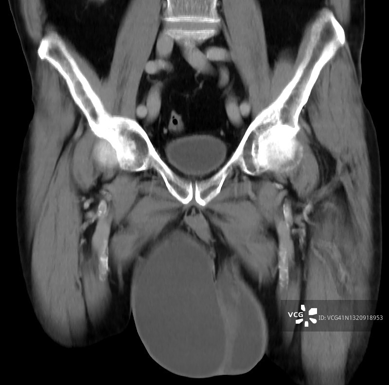 CT增强扫描显示的双侧鞘膜积液图片素材