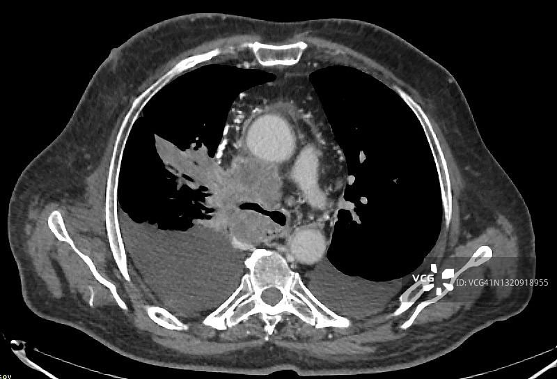 胸部和肺部CT图像：肺癌图片素材