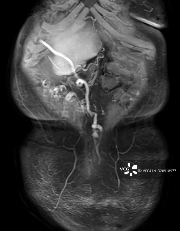 门静脉高压与脐静脉再通电脑断层扫描图像图片素材